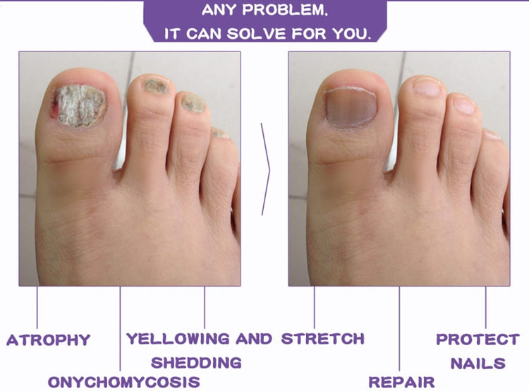 Nail Fungal Treatment Feet Care Essence Nail Foot Toe Nail Fungus Removal Gel Anti Infection Paronychia Onychomycosis