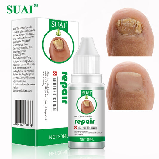 Nail Fungal Treatment Feet Care Essence Nail Foot Toe Nail Fungus Removal Gel Anti Infection Paronychia Onychomycosis